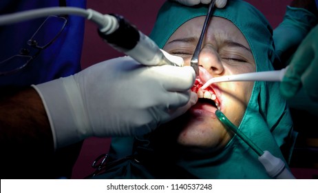 Oral Dental Surgery Operation, Tooth Gum Apicoectomy Cyst Removal