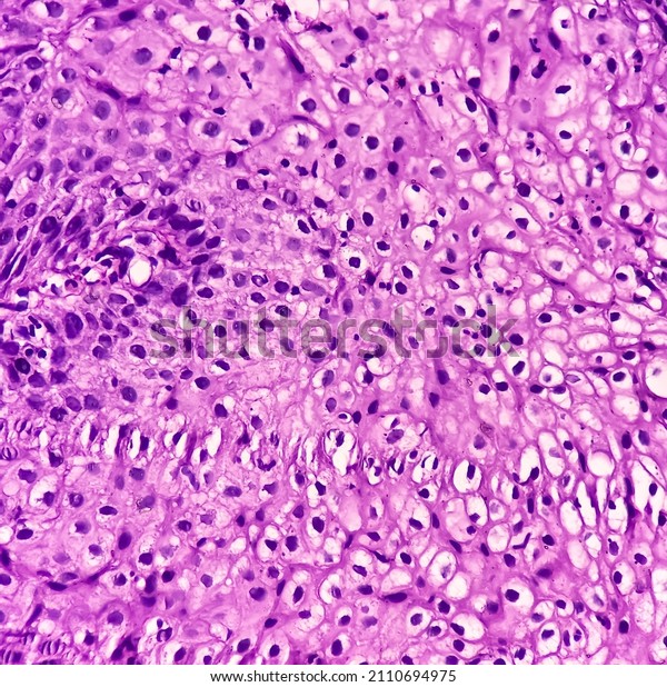 Oral mucosa carcinoma: Squamous cell\
carcinoma, poorly differentiated, show fibrocollagenous tissue,\
malignant neoplasm, atypical squamous epithelial\
cells.