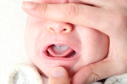Oral Thrush Of A Newborn Baby