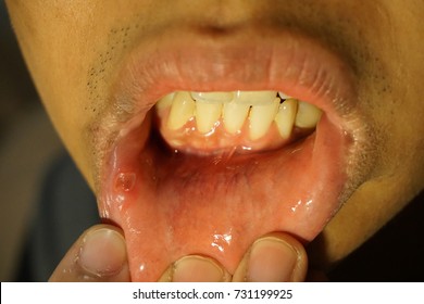 Oral Thrush Images, Stock Photos & Vectors 