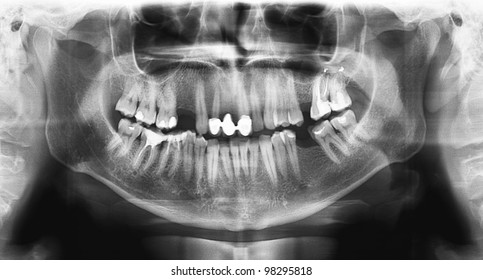 Original black white x-ray teeth scan mandible. Panoramic negative image facial of young adult male. Photo was taken on digital system equipment for dental diagnostic examination upon clinical checkup