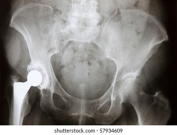 Original X-ray Image Of Woman's Pelvis With One Artificial Hip