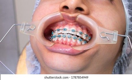 Orthodontic Patient Showing Her Braces


