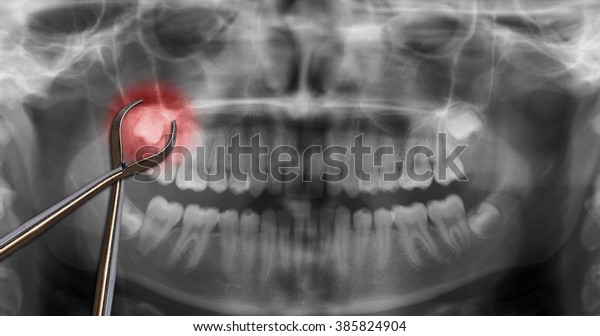 歯列矯正用ツールの智歯