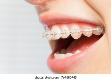 Orthodontics Correction Of Jaws With Clear Bracket