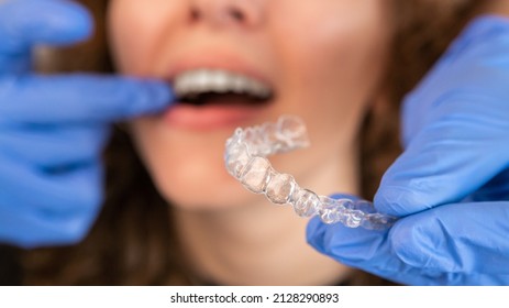Orthodontist doctor in gloves putting silicone invisible transparent braces on woman's teeth in dentist clinic, mouth closeup view. Correcting teeth treatment and cure in dentistry.