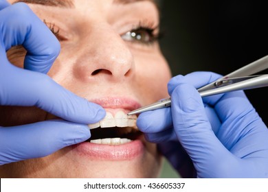 Orthodontist Fixing Invisible Ceramic Braces