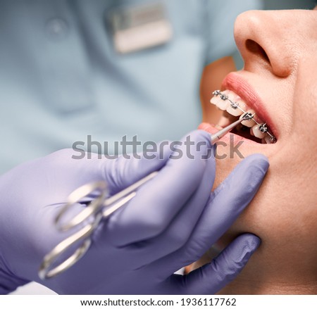 Orthodontist hands placing braces on woman teeth.
