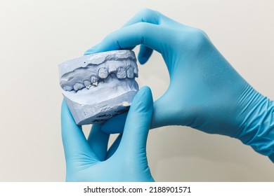 The orthodontist holds a cast of the child's jaw in his hands.