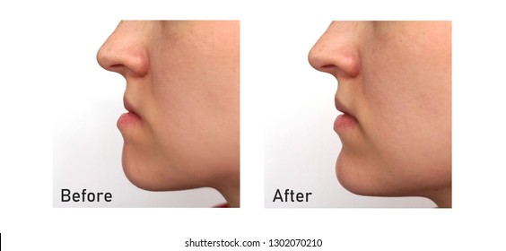 Orthognathic Surgery. Jaw Surgery. Malocclusion