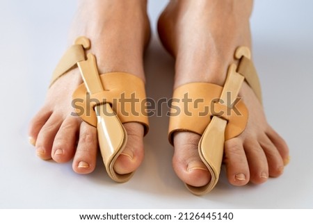 Orthopedic problems, Feet with an apparatus correcting for bunions, Treatment of bone degeneration 