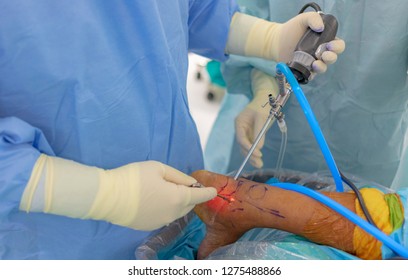 Orthopedic Surgeon Doing Ankle Arthroscope In Patient With Achilles Tendinopathy . Doctor Do The Posterior Approach For Treatment In Operating Room . Camera Port And Working Port In His Hands