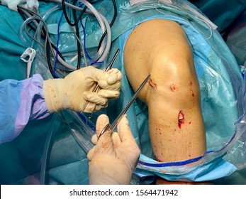 An Orthopedic Surgeon Performing A Suturing On A Knee Portal After An Arthroscopic Surgery.