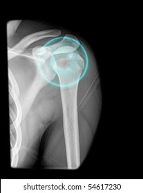 Orthopedic Techniques In Shoulder Treatement