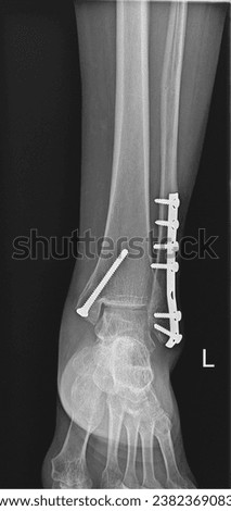 Orthopedic X-ray of a fractured tibia and fibula, displaying both lower leg bones.