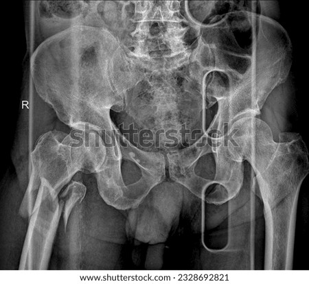 Orthopedic X-ray of Pelvis and Hip Fracture