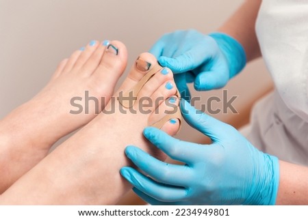 Orthopedist in blue gloves inserts a silicone impression to correction the ingrown toenail on the client's big toe. Close-up. The concept of podology and chiropody.