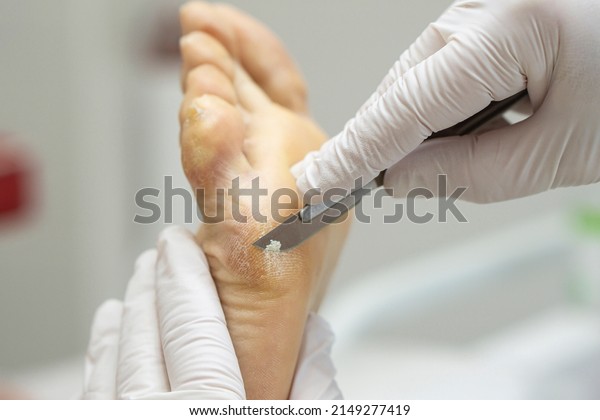 Orthopedist scalpel cuts off dry callus on the foot\
and on the toes