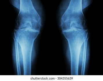 Osteoarthritis Knee Oa Knee Film Xray Stock Photo 304355636 | Shutterstock