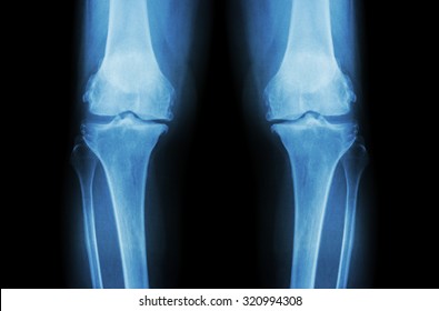 Osteoarthritis Knee ( OA Knee ). Film x-ray both knee ( front view ) show narrow joint space ( joint cartilage loss ) , osteophyte , subchondral sclerosis 