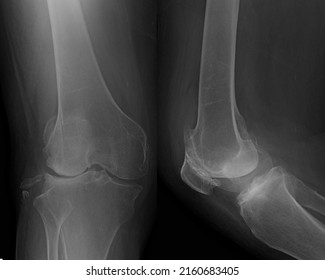 Osteoarthritis Knee. Show Narrow Joint Space, Osteophyte ( Spur ), Subchondral Sclerosis Due To Degenerative Change