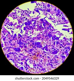 Osteoclast Like Giant Cells. Light Micrograph Of A Giant Cell Tumour Of Lower End Of Right Femur Showing Giant Cells Derived From Osteoclasts.