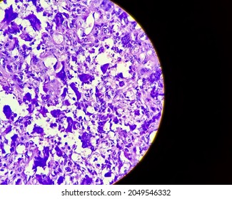 Osteoclast Like Giant Cells. Light Micrograph Of A Giant Cell Tumour Of Lower End Of Right Femur Showing Giant Cells Derived From Osteoclasts.