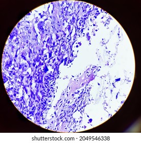 Osteoclast Like Giant Cells. Light Micrograph Of A Giant Cell Tumour Of Lower End Of Right Femur Showing Giant Cells Derived From Osteoclasts.