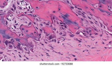 Osteoclasts (bone Eating Cells) Lining Scalloped Edges Of Bone. Each Osteoclast Cell Has Multiple Nuclei. See Also Osteoblasts.