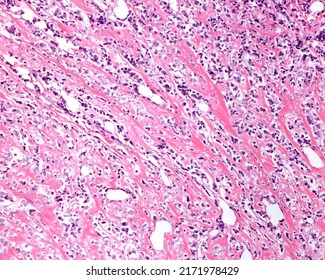 Osteogenic Sarcoma. Light Microscope Micrograph Showing Anaplastic Tumour Cells Producing Neoplastic Osteoid (bone Matrix) Which Appears As Elongated Uncalcified Bone Trabeculae.