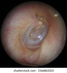 Otitis Media With Effusion, Right Ear