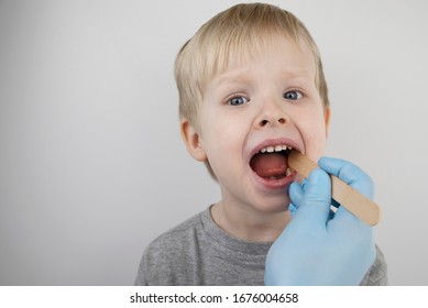 An otolaryngologist examines a child's throat with a wooden spatula. A possible diagnosis is inflammation of the pharynx, tonsils or pharyngitis. 