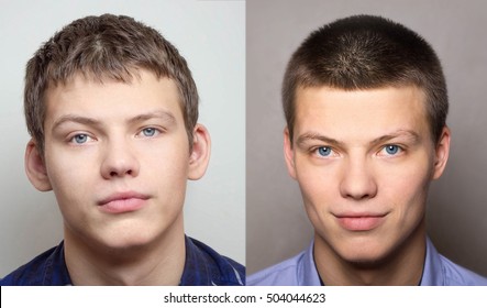otoplasty - before and after the operation - Shutterstock ID 504044623