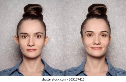 otoplasty - before and after the operation - Shutterstock ID 665187415
