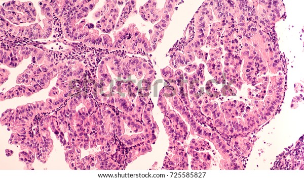 Ovarian Cancer Awareness: Micrograph of a\
serous papillary carcinoma (adenocarcinoma) of ovary, with\
intricately branching papillae. This tumor has a poor prognosis, as\
early detection is\
problematic.