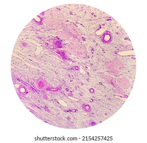 Ovarian Cyst: Cystic Teratoma, Microscopic Show Skin, Adenexal Structure, Fatty Tissue, Salivary Acini And Cartilage. Most Common Ovarian Neoplasm, Benign Tumor

