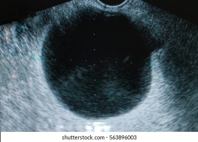 Ovarian Cyst Medical Ultrasound Diagnostics