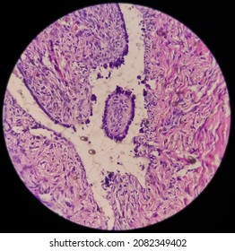 Ovarian Cyst, Serous Cyst Adenofibroma, Relatively Rare Benign Ovarian Tumor, Photo Under Light Microscope 40x View