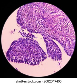 Ovarian Cyst, Serous Cyst Adenofibroma, Relatively Rare Benign Ovarian Tumor, Photo Under Light Microscope 40x View