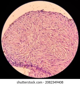 Ovarian Cyst, Serous Cyst Adenofibroma, Relatively Rare Benign Ovarian Tumor, Photo Under Light Microscope 40x View