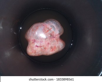 Ovarian Cysts That Are Removed During Surgery