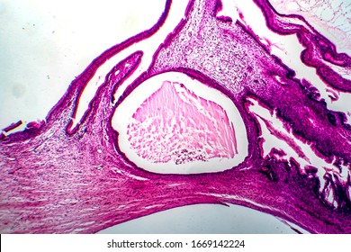 Ovarian Mucinous Cystadenoma, A Benign Tumor Of Ovary, Light Micrograph, Photo Under Microscope