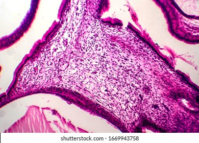 Ovarian Mucinous Cystadenoma, A Benign Tumor Of Ovary, Light Micrograph, Photo Under Microscope