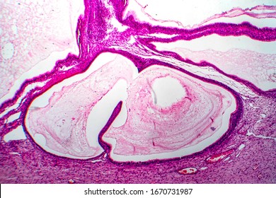 Ovarian Mucinous Cystadenoma, A Benign Tumor Of Ovary, Light Micrograph, Photo Under Microscope