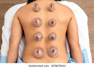 Overhead View Of Unrecognized Woman Receiving Cupping Treatment On Her Back While Lying On Stretcher.