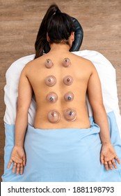 Overhead View Of Unrecognized Woman Receiving Cupping Treatment On Her Back While Lying On Stretcher.