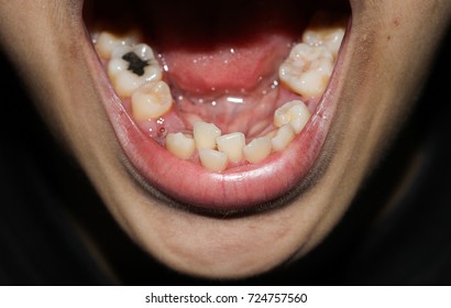 Overlap Teeth, Crowding Tooth, Decayed Tooth
