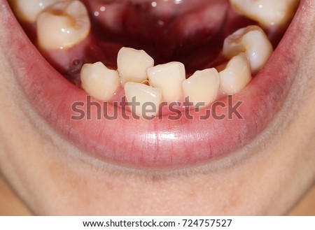 overlap teeth, crowding tooth, decayed tooth
