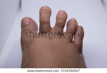 Overlapping toes, one of congenital foot disorders.