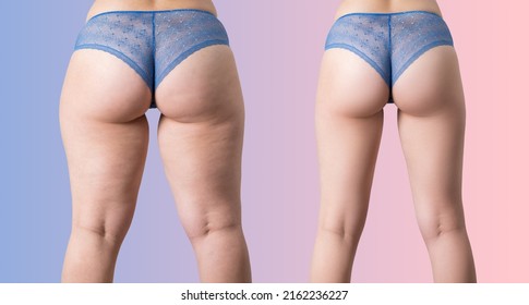Overweight woman and fat cellulite legs   buttocks  before after weight loss concept  obesity female body purple pink gradient background  BeH3althy